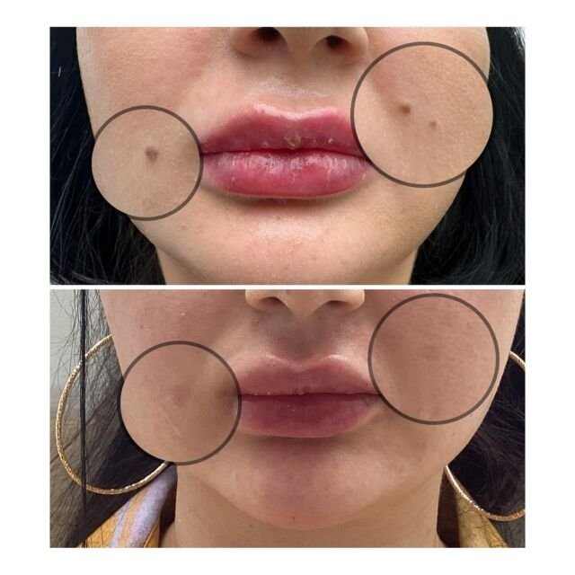 7D HIFU Facial Treatment: The Ultimate Non-Surgical Facelift