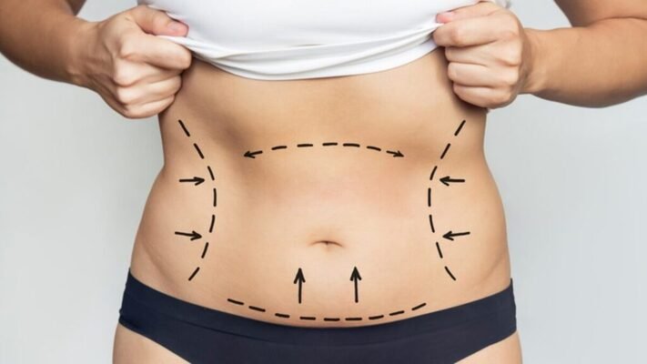 liposuction in Dubai