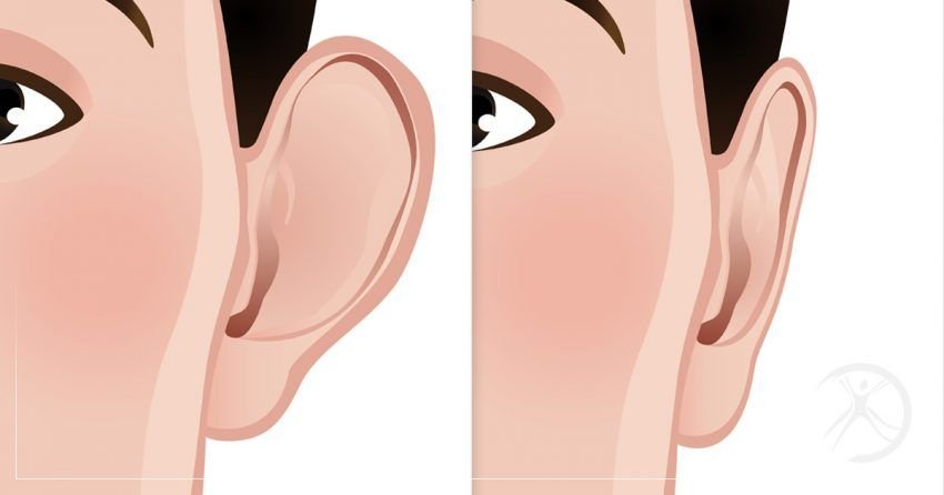Ear Reshaping in Islamabad: Achieve Balanced and Natural Ears