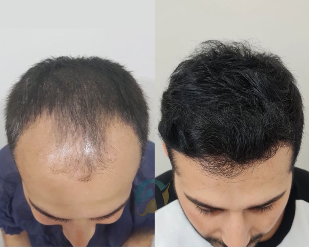 Hair Transplant in Islamabad: Regain Your Hair and Confidence